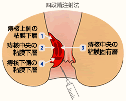 ジオン（ALTA）療法について