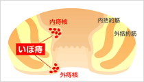 いぼ痔（痔核）