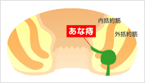 あな痔（痔ろう）